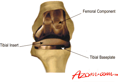 典型膝关节置换术，显示股骨和胫骨的假体