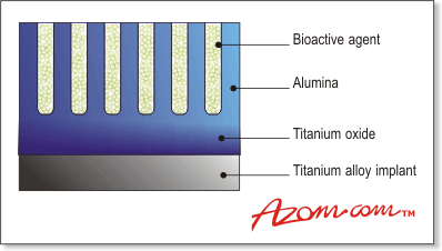 AZoM——金属、陶瓷、聚合物和复合材料:Schamtic改进的多孔涂层植入生活全髋置换和其他植入物